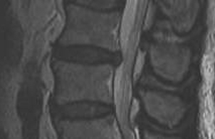 Lumbar Disc Protrusion